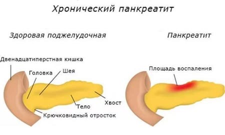 Хронический панкреатит 