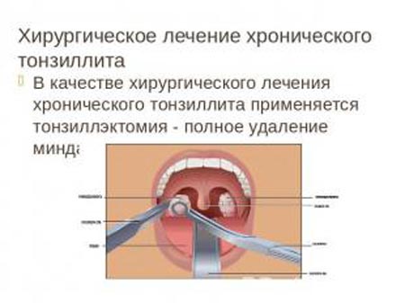 Хирургическое лечение хронического тонзиллита
