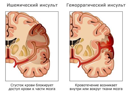 Виды инсульта