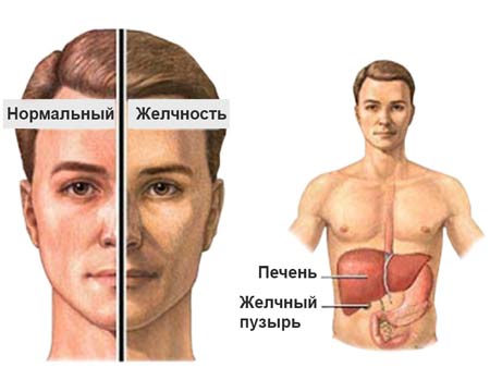 Синдром Жильбера 