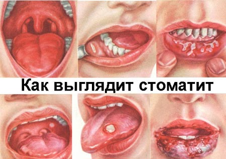 Стоматит 