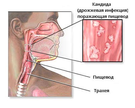 Кандидоз пищевода
