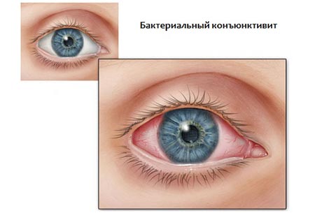 Бактериальный конъюнктивит