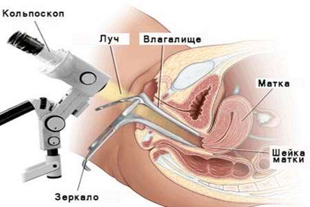 Кольпоскопический осмотр шейки матки