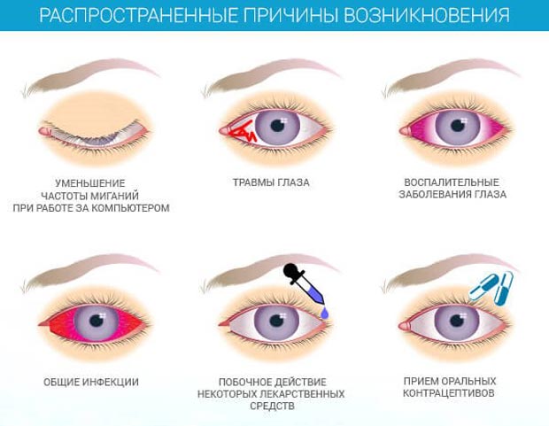 Причины конъюнктивита