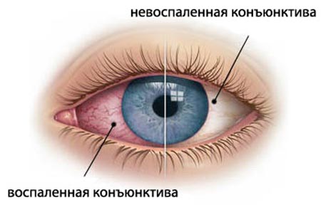 Конъюнктивит
