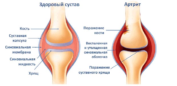 Здоровый сустав и артрит 