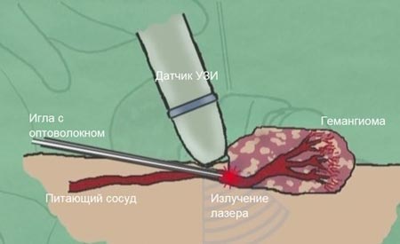 Лечение гемангиомы