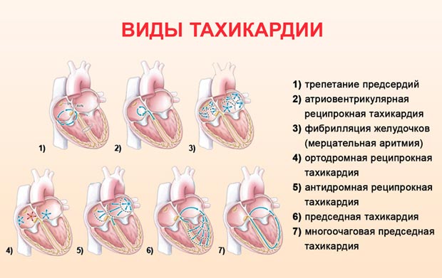 Виды тахикардии