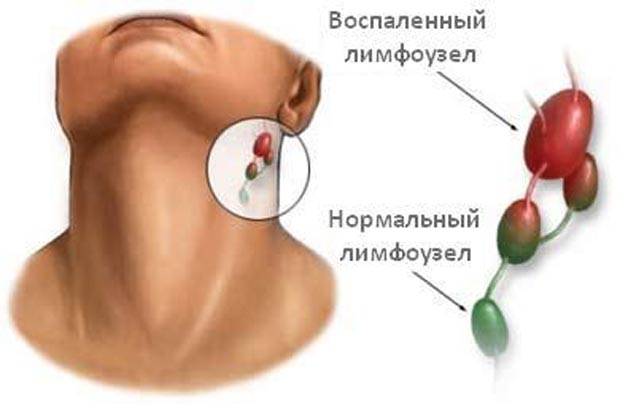 Лимфаденит