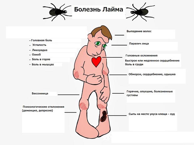 Симптомы болезни Лайма