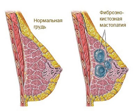 Фиброзно-кистозная мастопатия