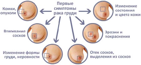 Симптомы мастопатии