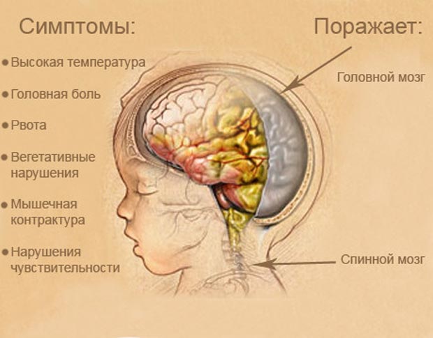 Симптомы менингита