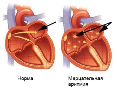 Мерцательная аритмия