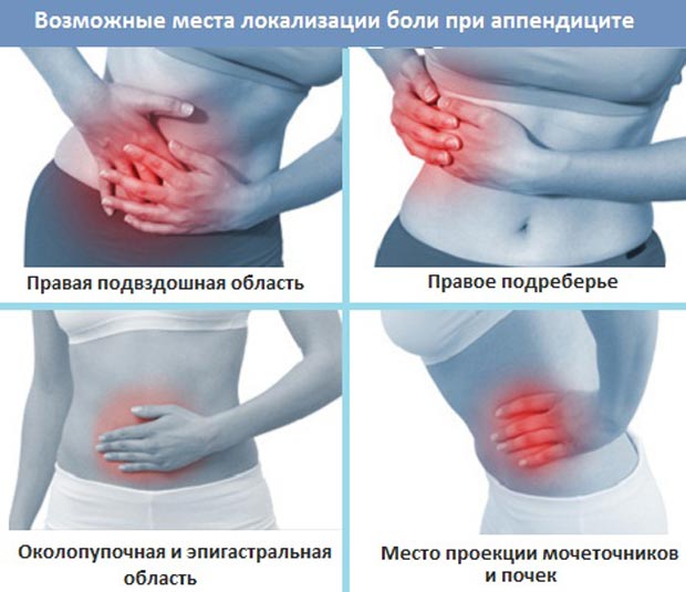 Места локализации боли при аппендиците 