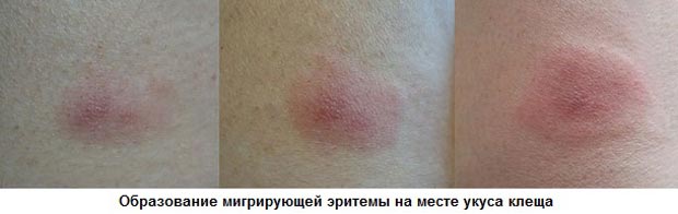 Место укуса
