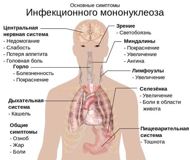 Симптомы мононуклеоза