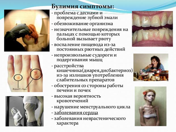 Симптомы булимии