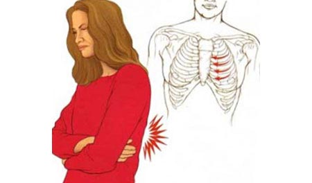 Межреберная невралгия