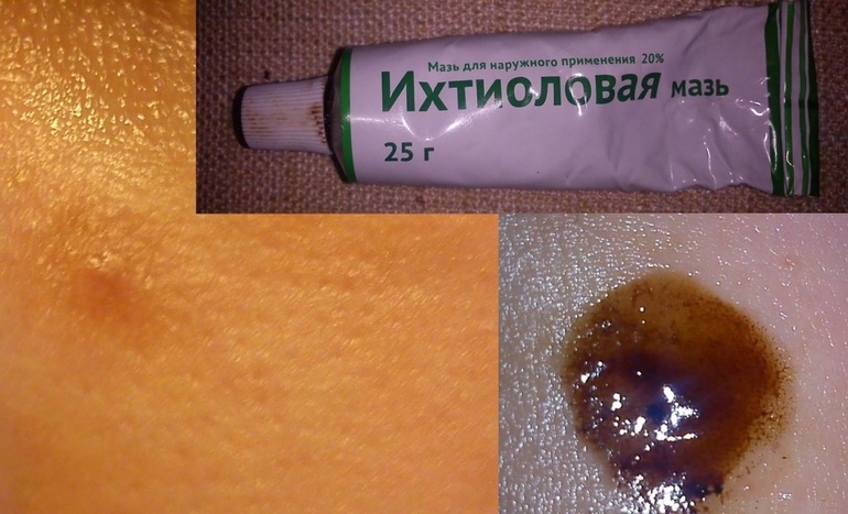 Особенности применения ихтиолки