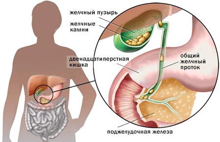 Острый калькулезный холецистит