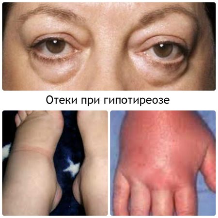 Отеки при гипотиреозе