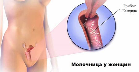 Молочница у женщин