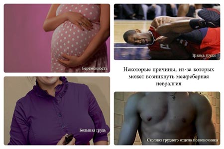 Причины межреберной невралгии