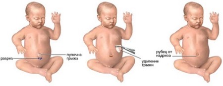 Пупочная грыжа у детей