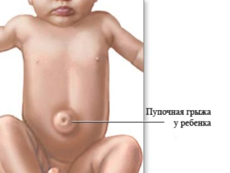 Пупочная грыжа у ребенка