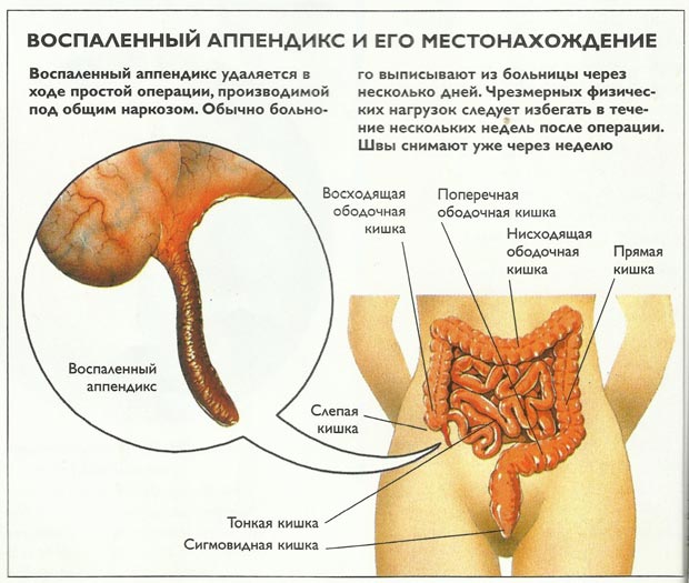 Местонахождение аппендикса