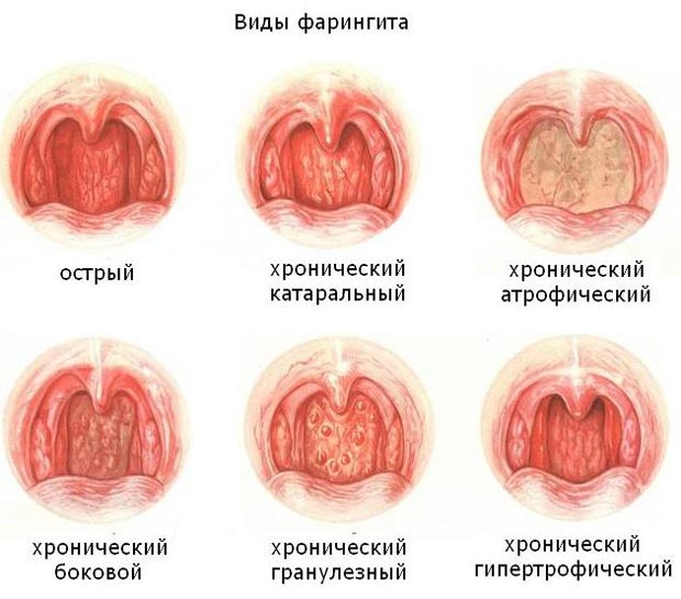 Виды фарингита