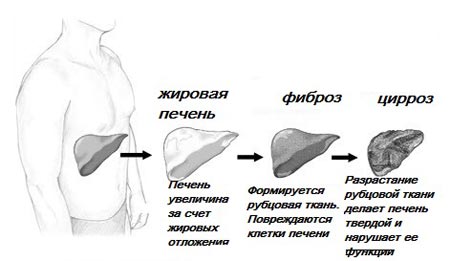 Цирроз печени