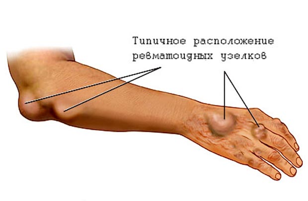 Ревматоидные узелки при ревматизме