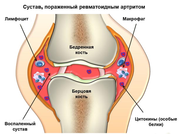 Сустав, пораженный ревматоидным артритом 
