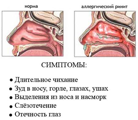 Симптомы ринита