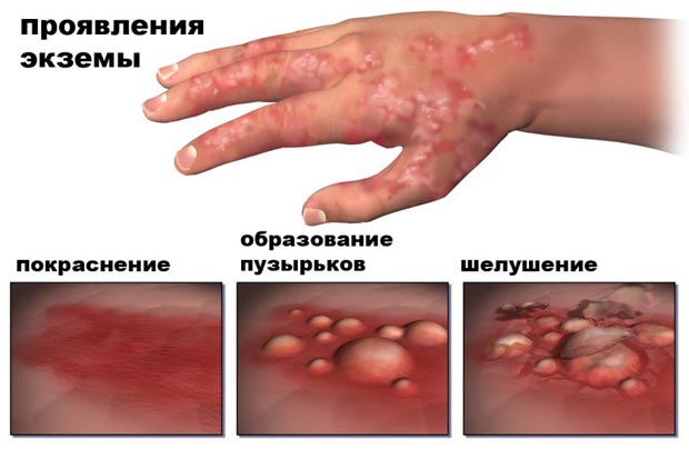 Проявления экземы 
