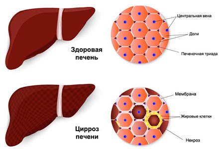 Цирроз печени