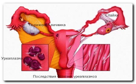 Последствия болезни уреаплазмоз