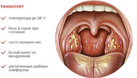 Симптомы тонзиллита