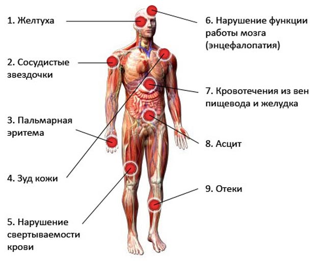 Симптомы цирроза печени