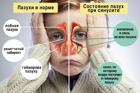 Синусит