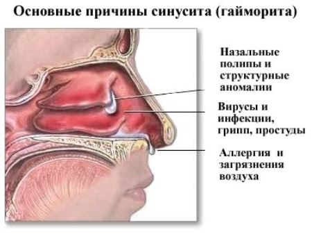 Причины синусита