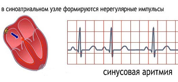Синусовая аритмия