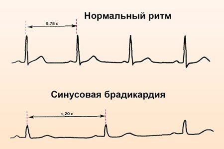 Синусоидальная брадикардия на ЭКГ