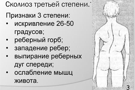 Сколиоз третьей степени