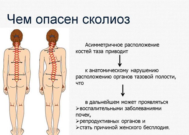 Чем опасен сколиоз