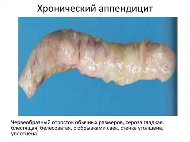 Хронический аппендицит