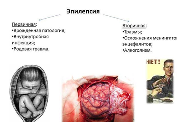 Причины эпилепсии